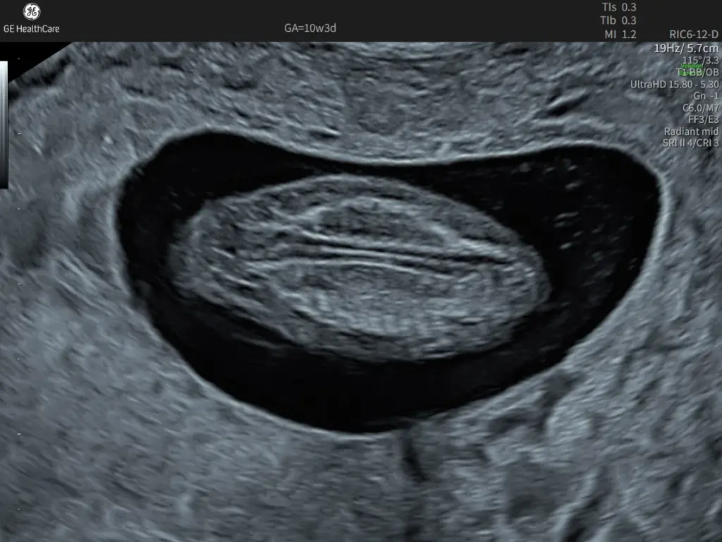 10 week fetal spine with UltraHD and Radiant