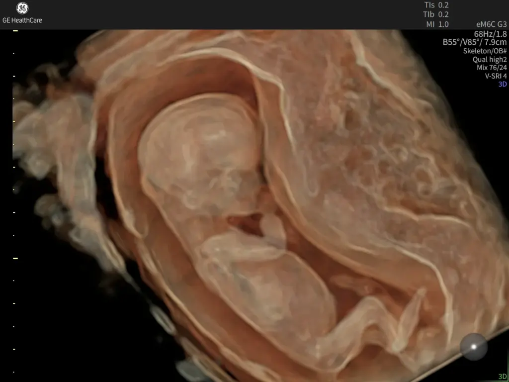 12 week fetus with HDlive