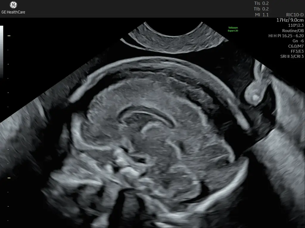 2D fetal brain
