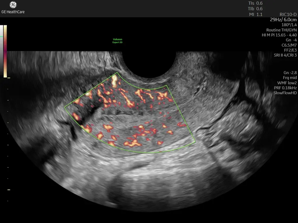2D uterus with SlowflowHD