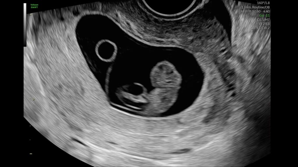 9 Week Fetus