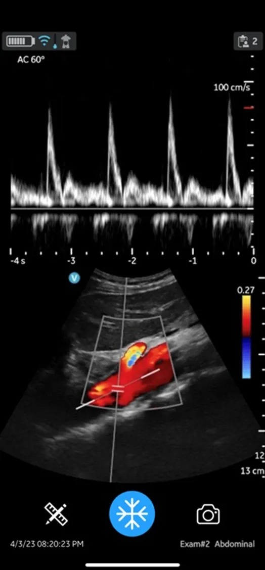 Abdominal Aorta with Color Flow and PW Doppler
