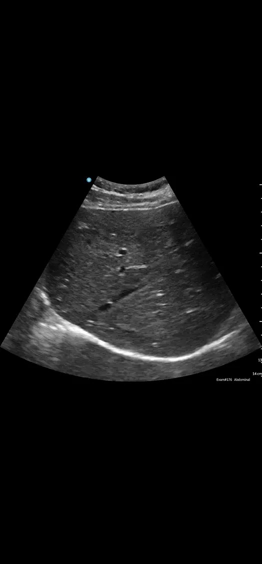 Rt Lobe Liver