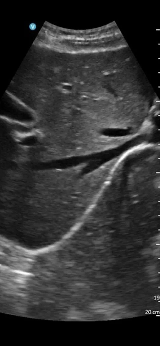 Transverse Liver with Hepatics