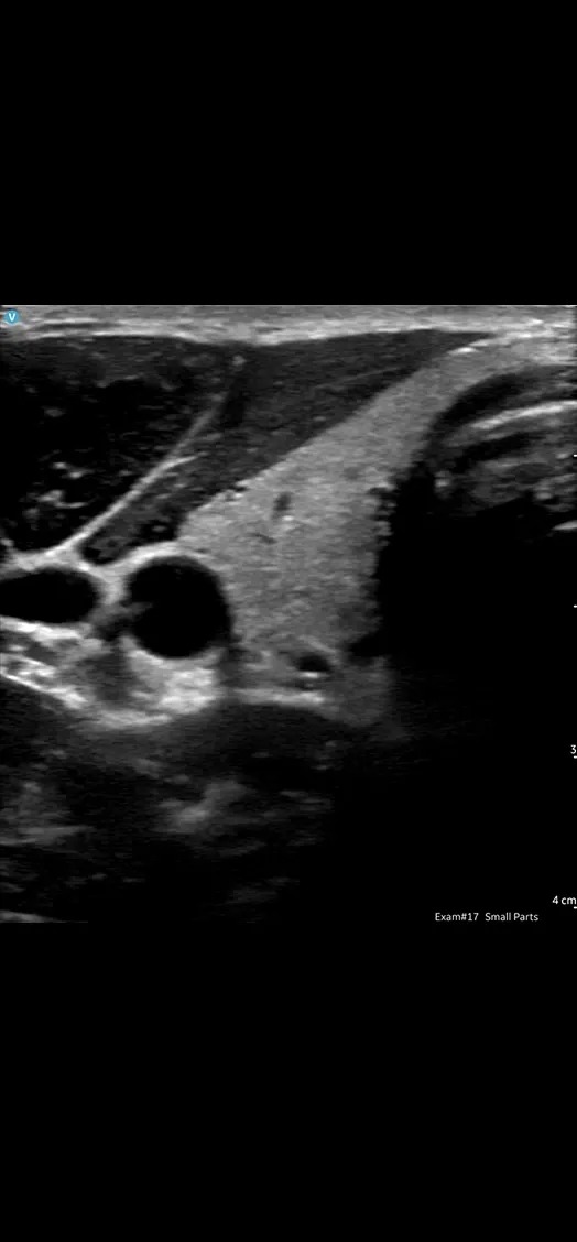 Transverse Thyroid Lobe