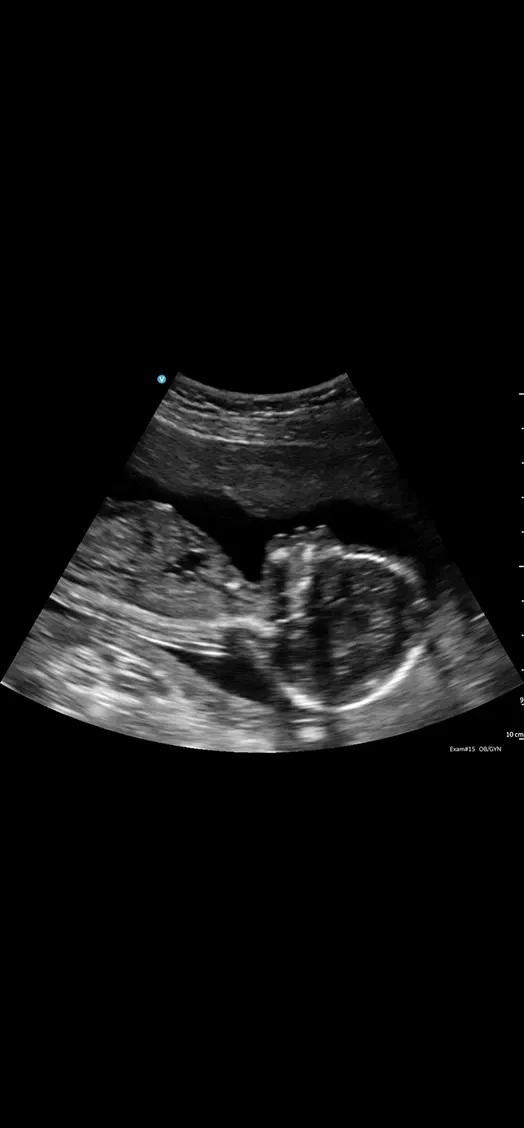 Fetal Profile