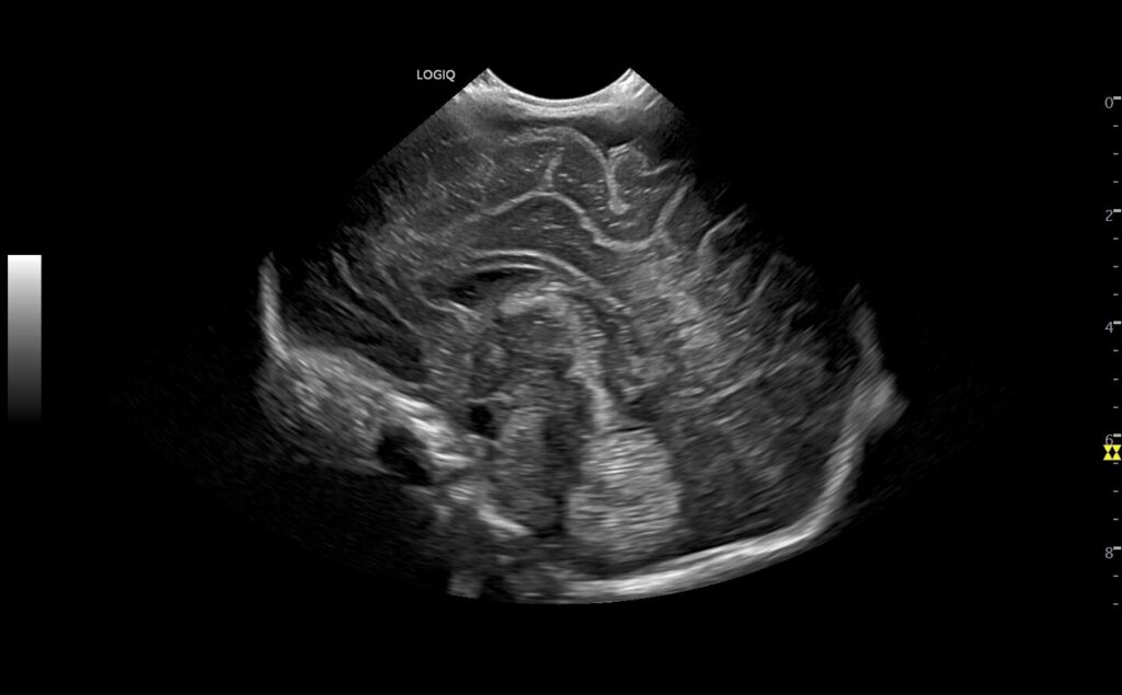 Neonatal Head B-Mode C3-10-D