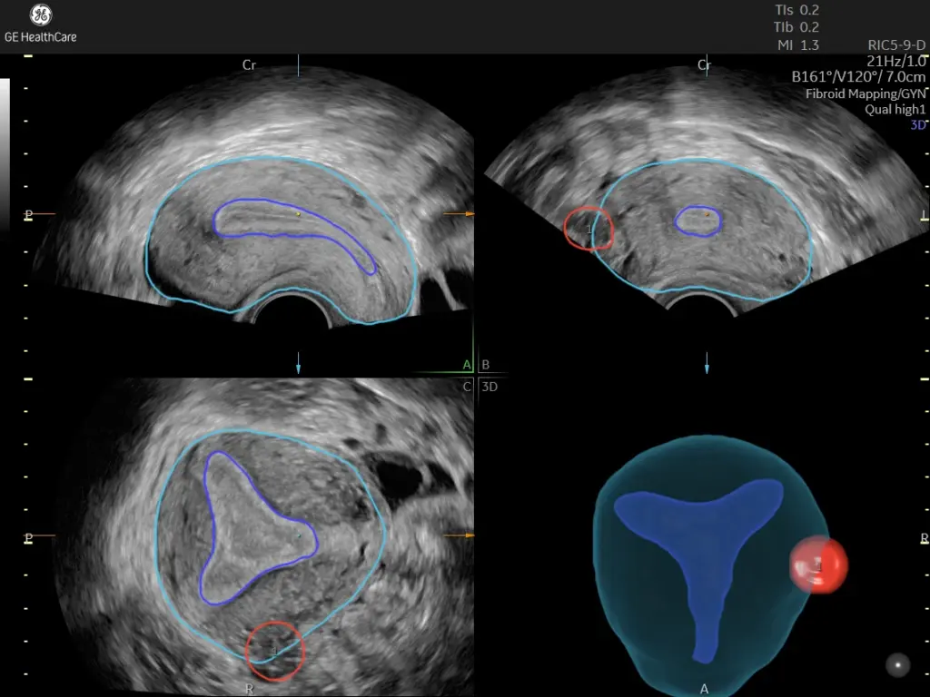 Uterine fibroids