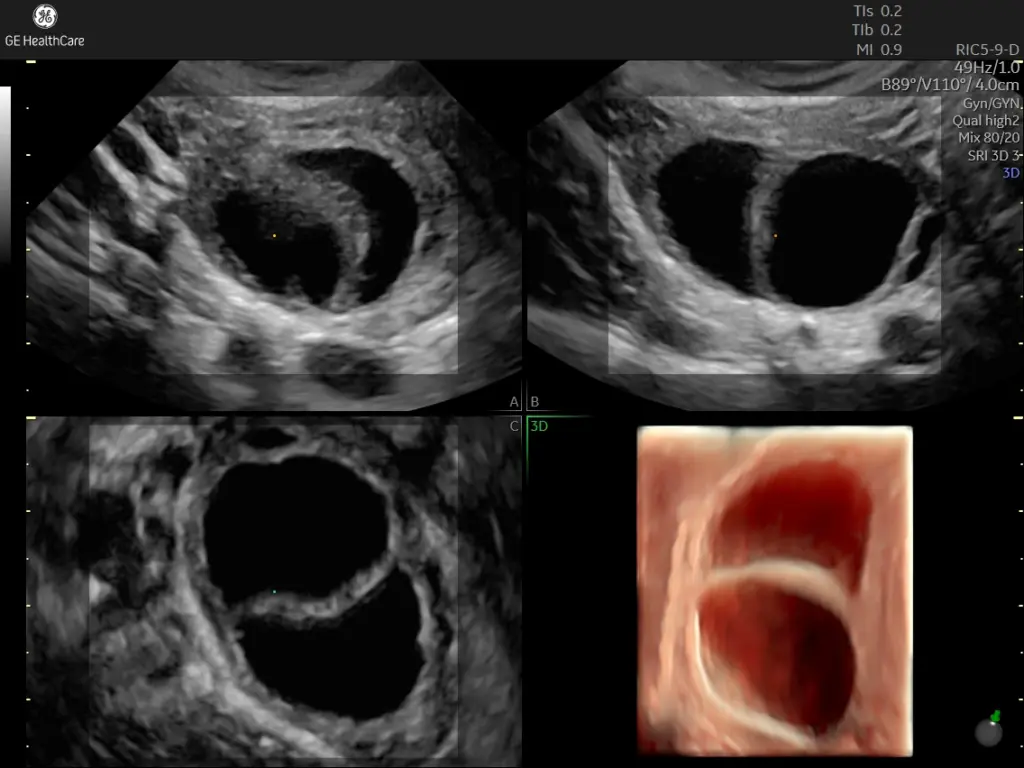 Ovarian cysts