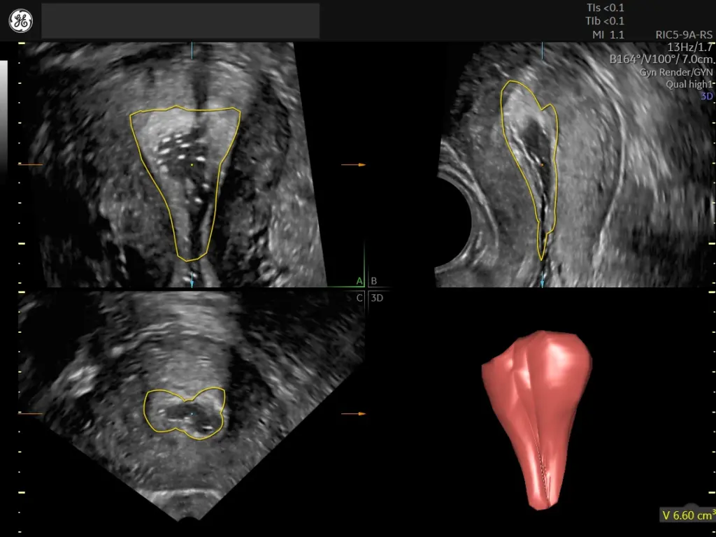 Endometrium