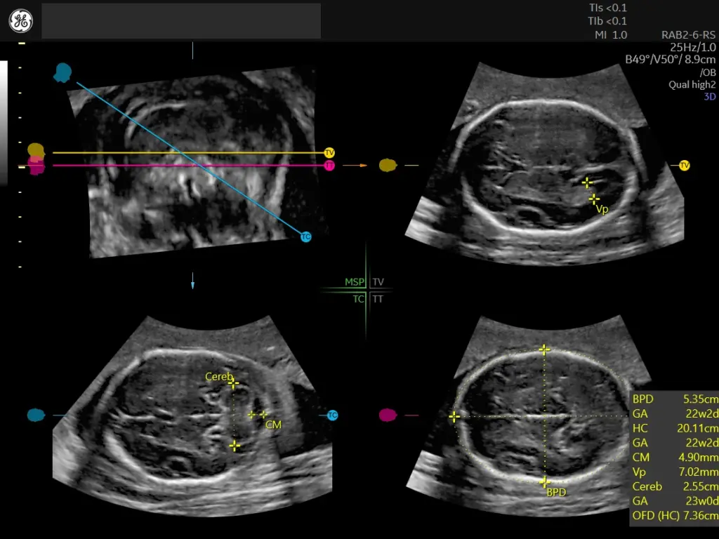 23-week fetal brain