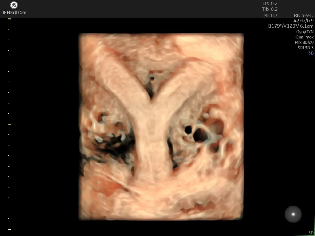Septate uterus
