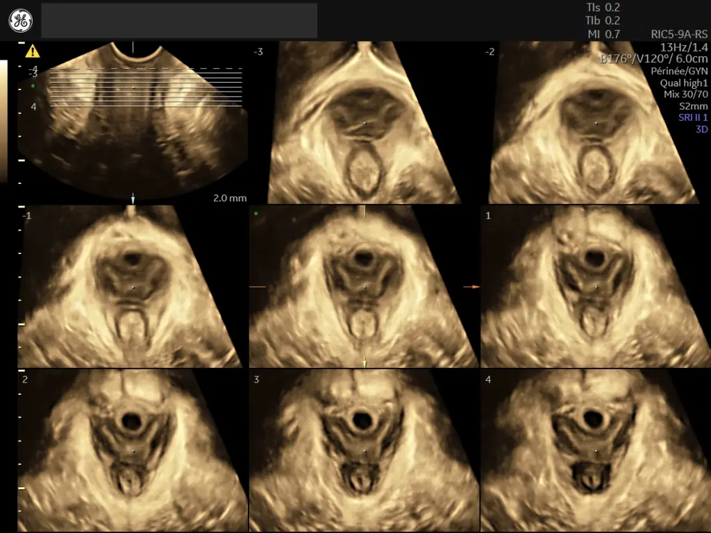 Pelvic floor - TUI