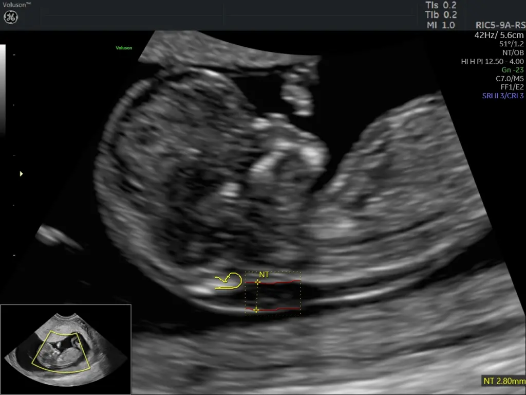 12-week nuchal translucency