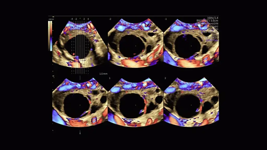TUI PelvicHealth RadiantFlow Ovarian Cyst