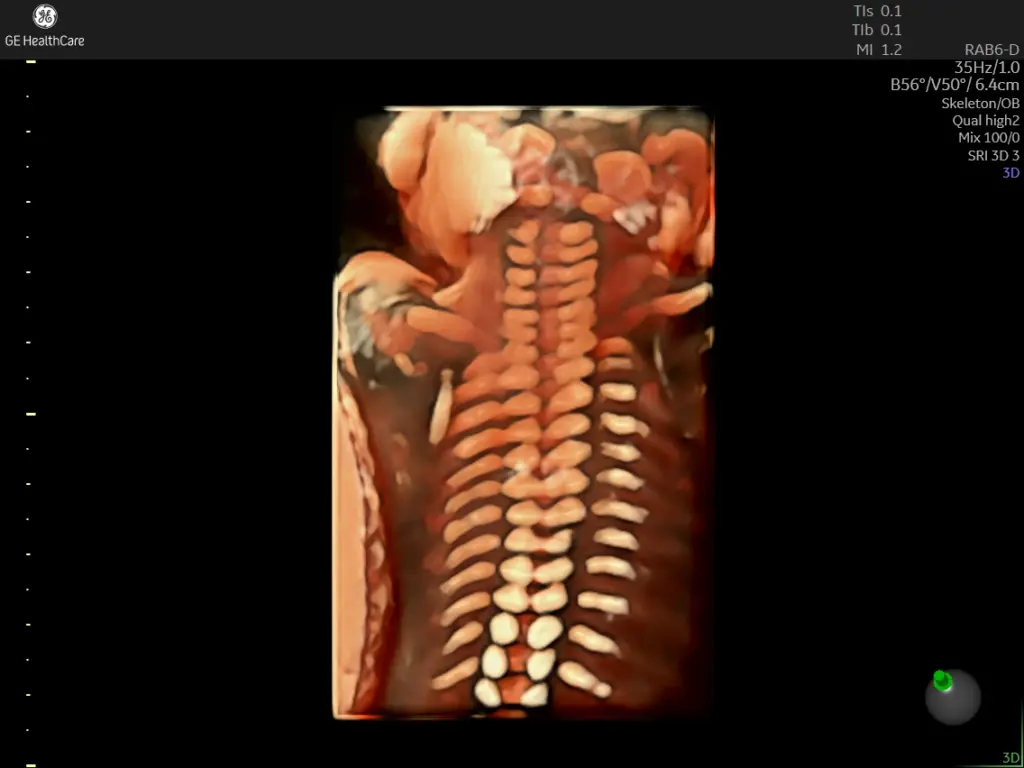 Fetal spine