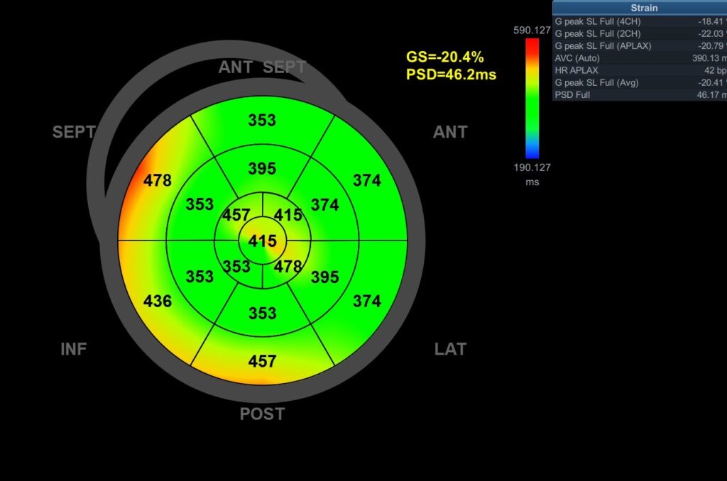 Peak Strain Dispersion