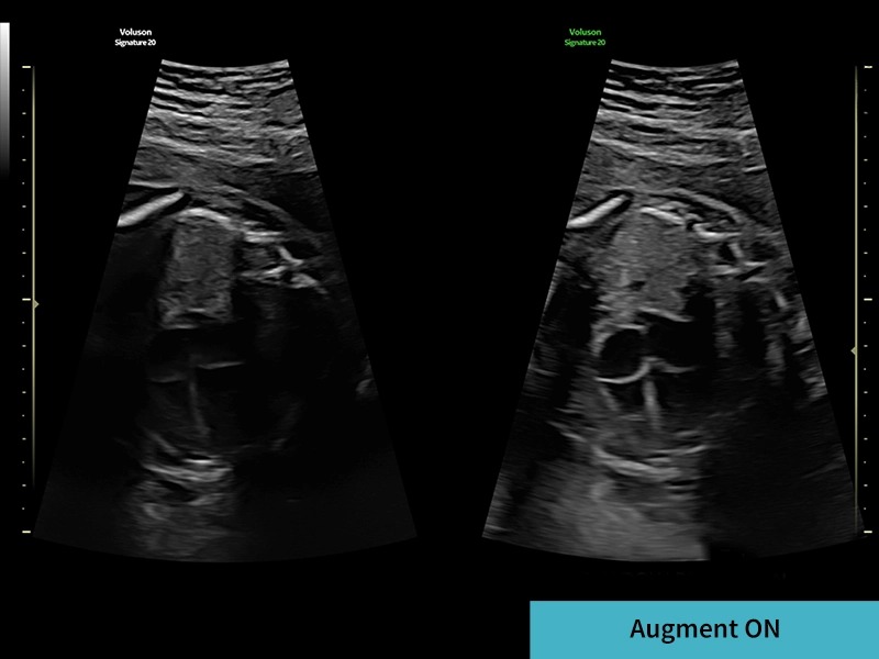 Augment ON
