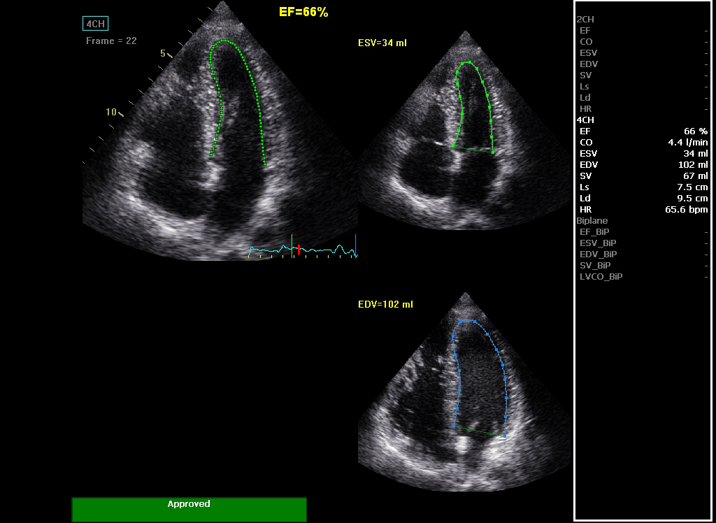 Auto Ejection Fraction