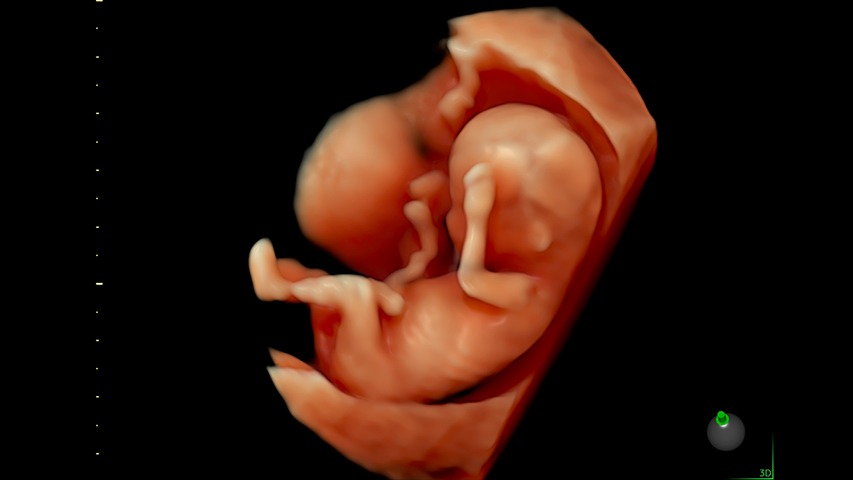 12 Week Fetus