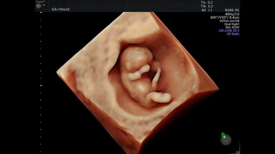 10 Week Fetus