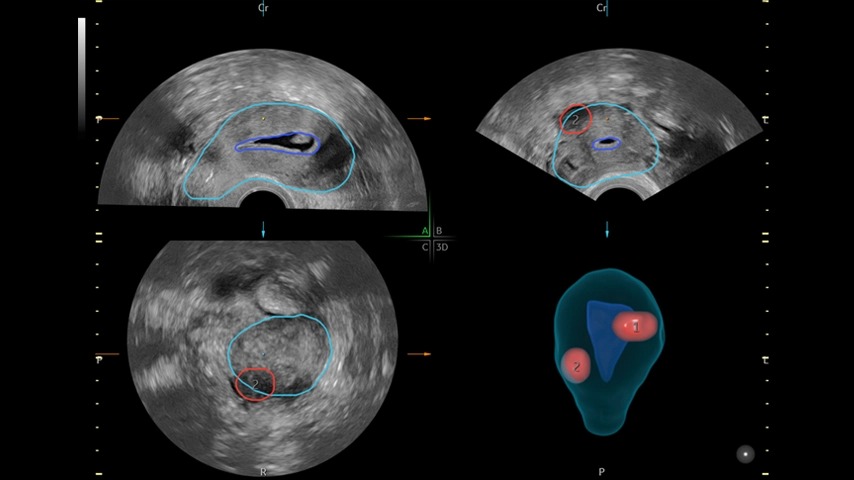 SonoGyn