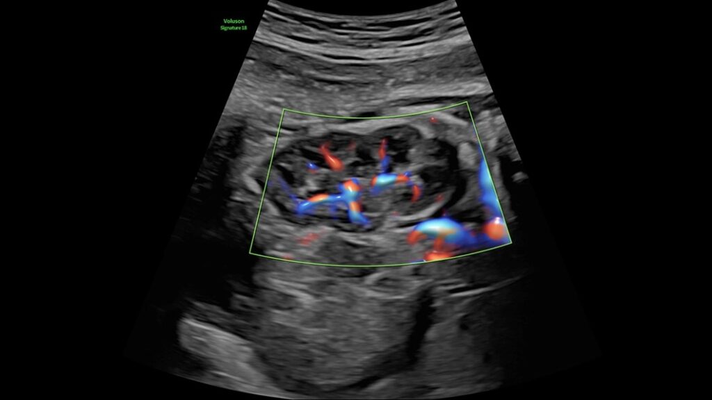 Fetal Kidney