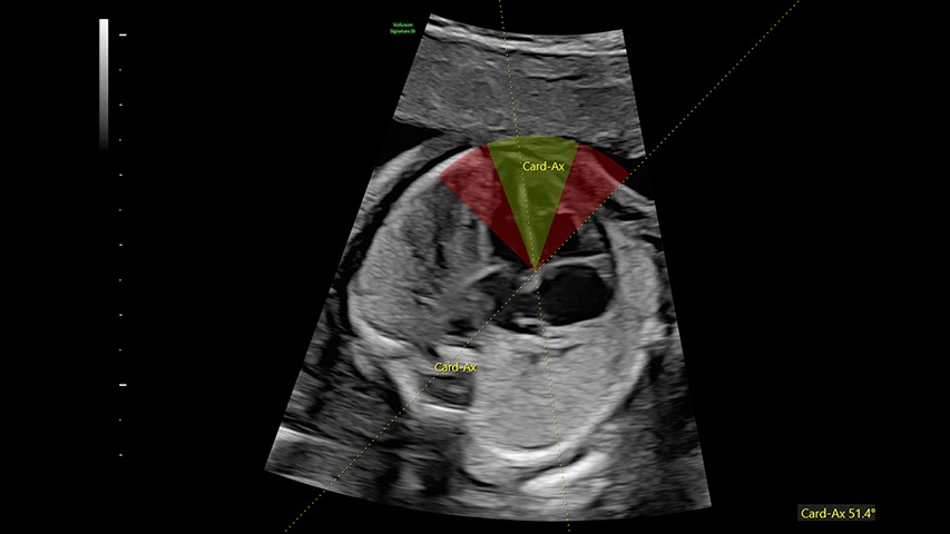 Fetal HS
