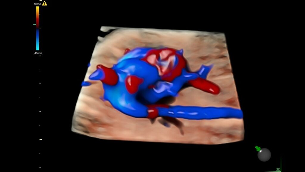 Fetal Heart with HD Live Flow