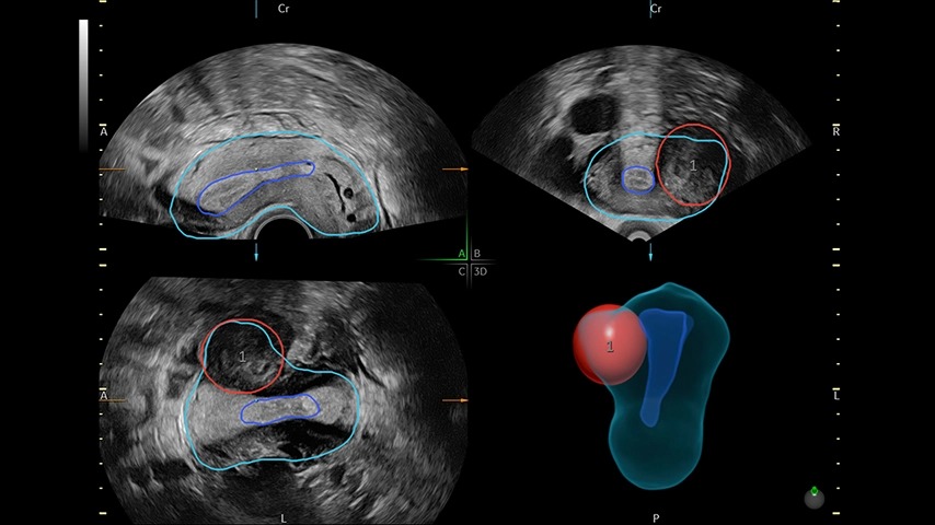 SonoGyn