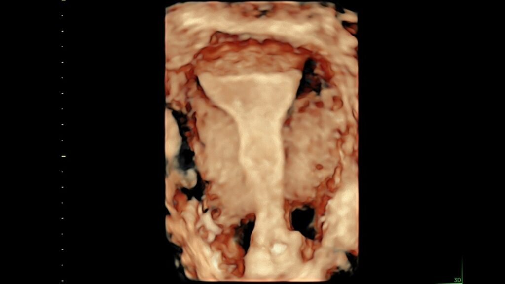 Uterus with HD Live