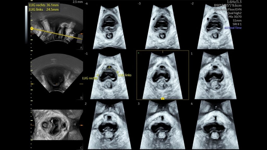 Sono Pelvic Floor