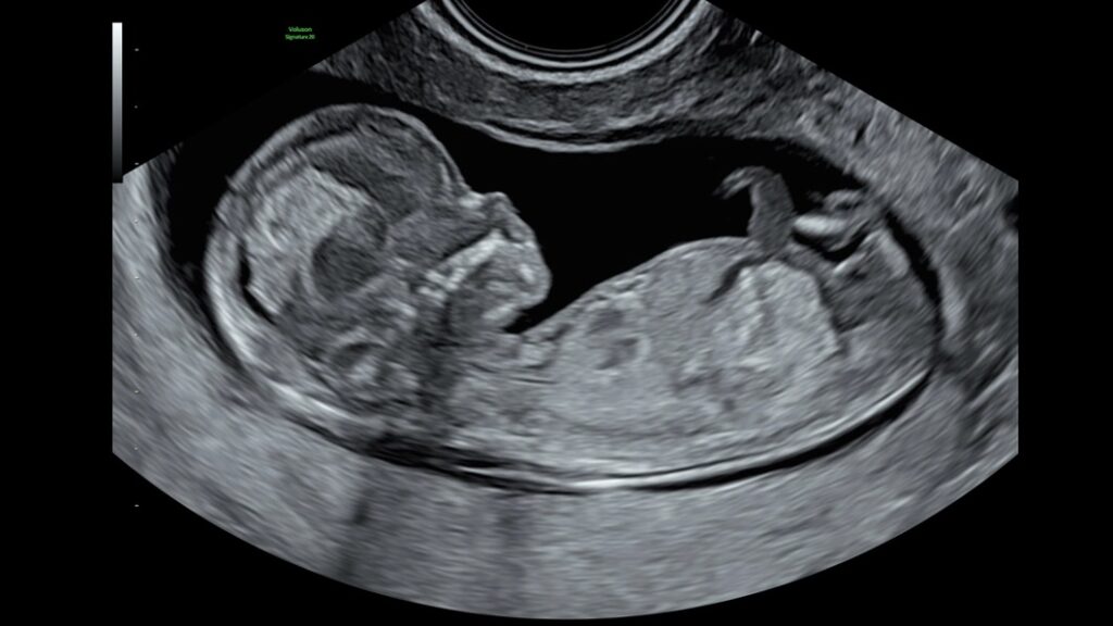 12 Week Fetus