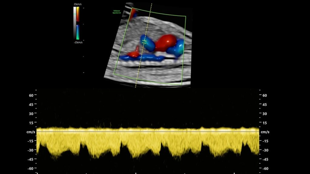 Pulse Wave Doppler of Ductus