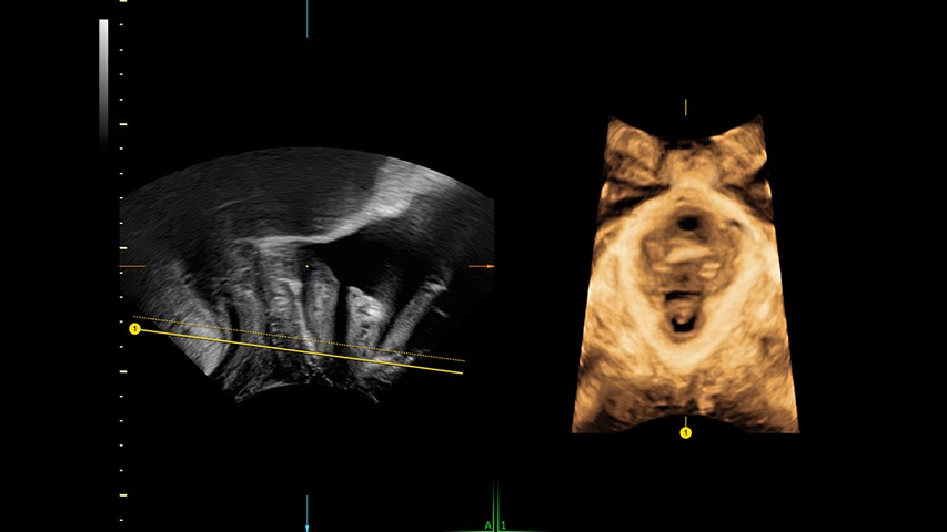 Sono Pelvic Floor