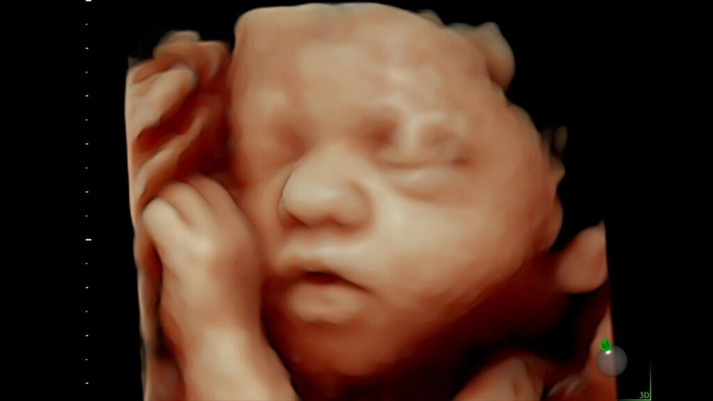 Fetal Face with HD Live