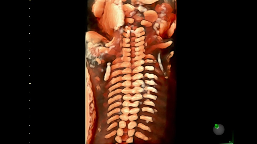 Fetal Spine with HD Live