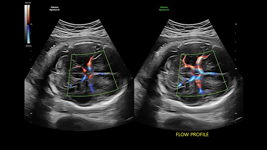 Flow Profiles