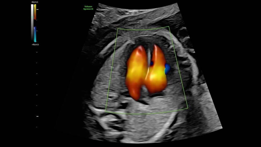 26 Week Fetal HEart