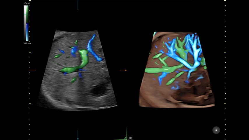 Fetal Abdomen with HD Flow