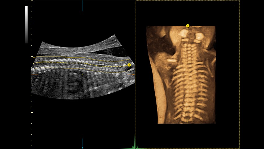 Spine Trace