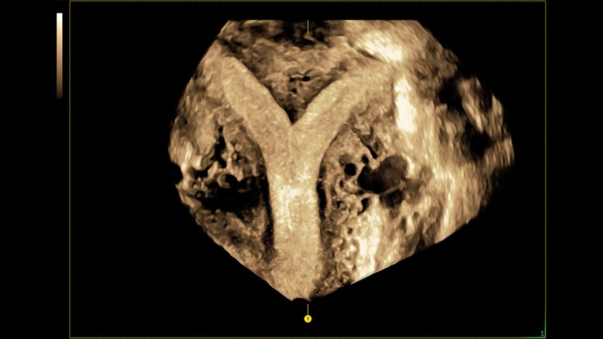Uterus Uterine Trace