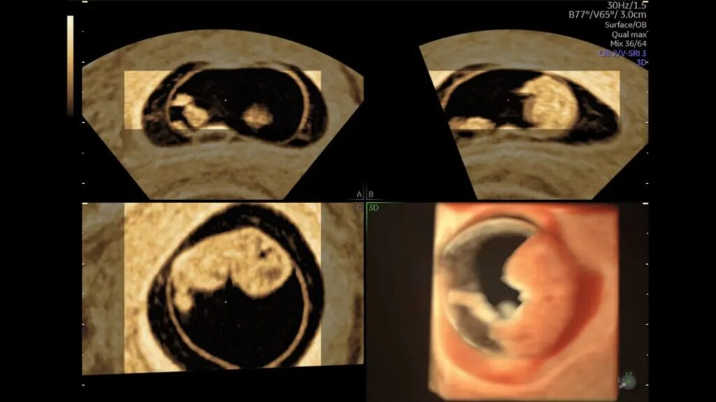 8 Week Embryo