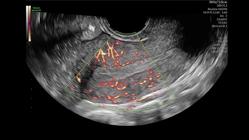 Uterus