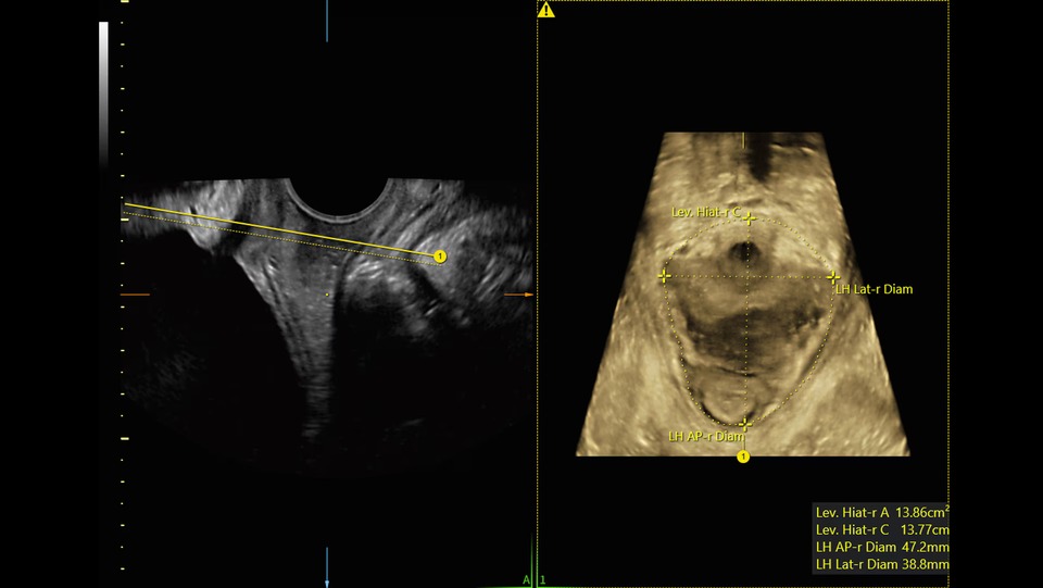 Sono Pelvic Floor