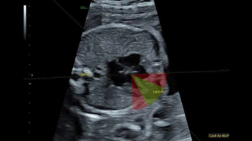 Fetal HS