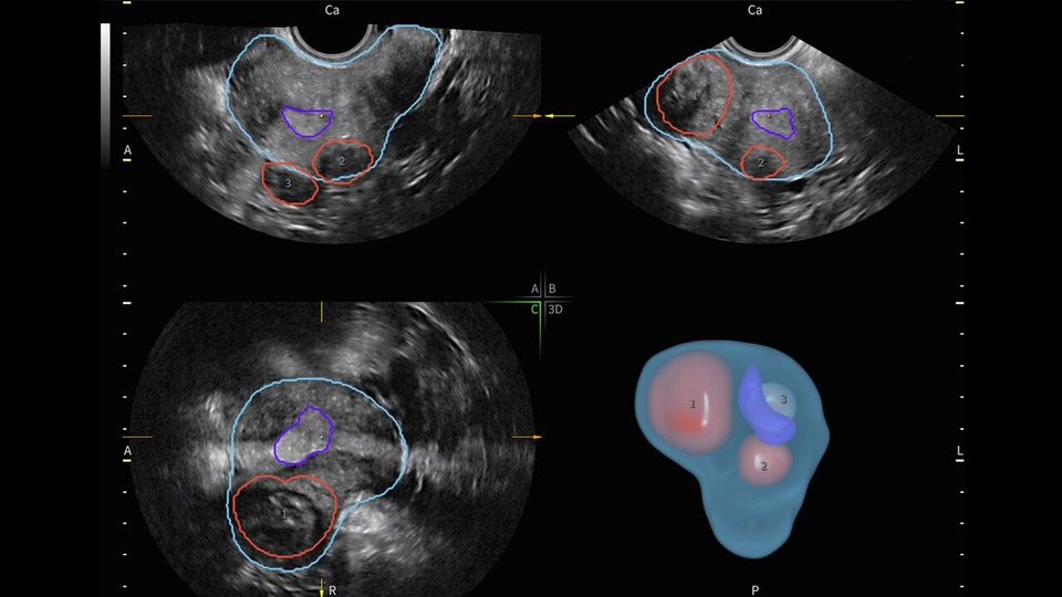 Fibroid Mapping