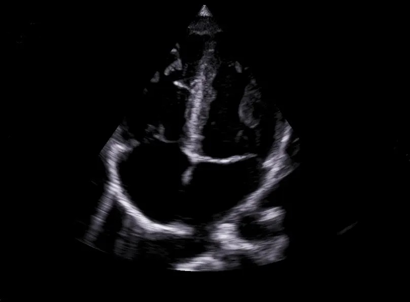 Apical 4 Chamber view, VScan Air SL - Sector