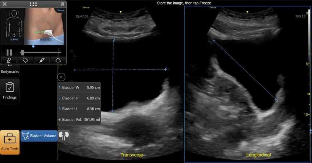 Blooder Volume Tool, Split Screen, VScan Air CL - Curved