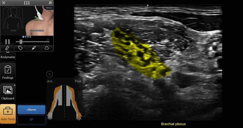 cNerve, Brachial Plexus Vscan Air CL - Linear